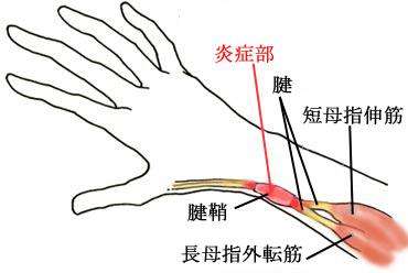 腱鞘炎的病因是什么