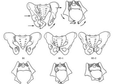 骨盆骨折的分类.jpg